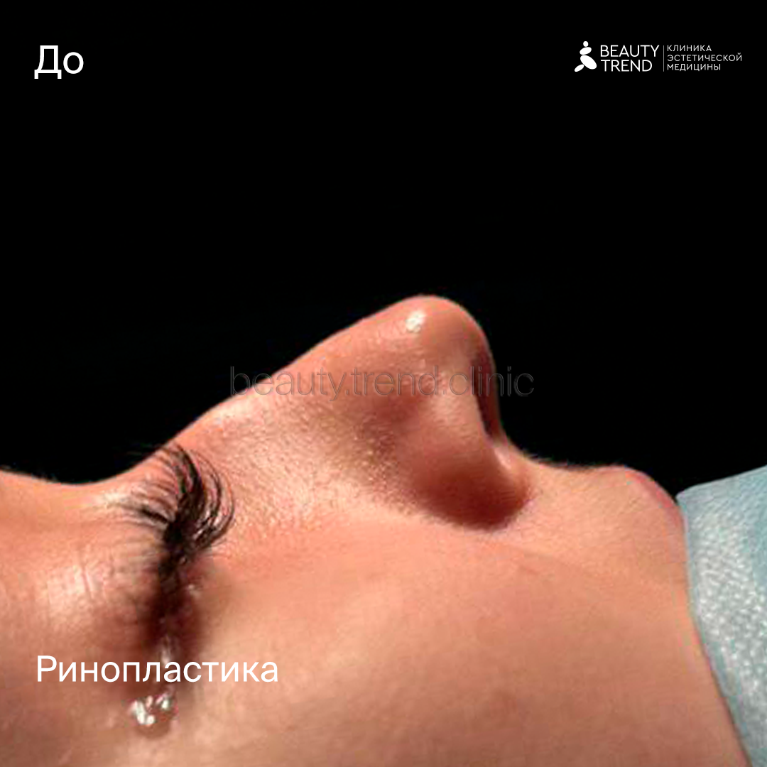 Ринопластика, Еремейшвили - до 1